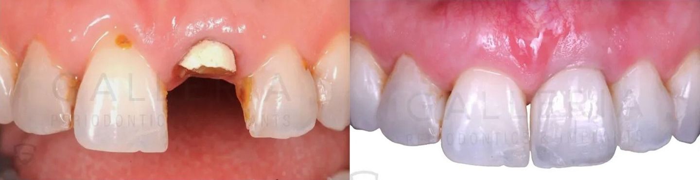 Anterior Implant to Replace Broken Tooth & Recession Treatment