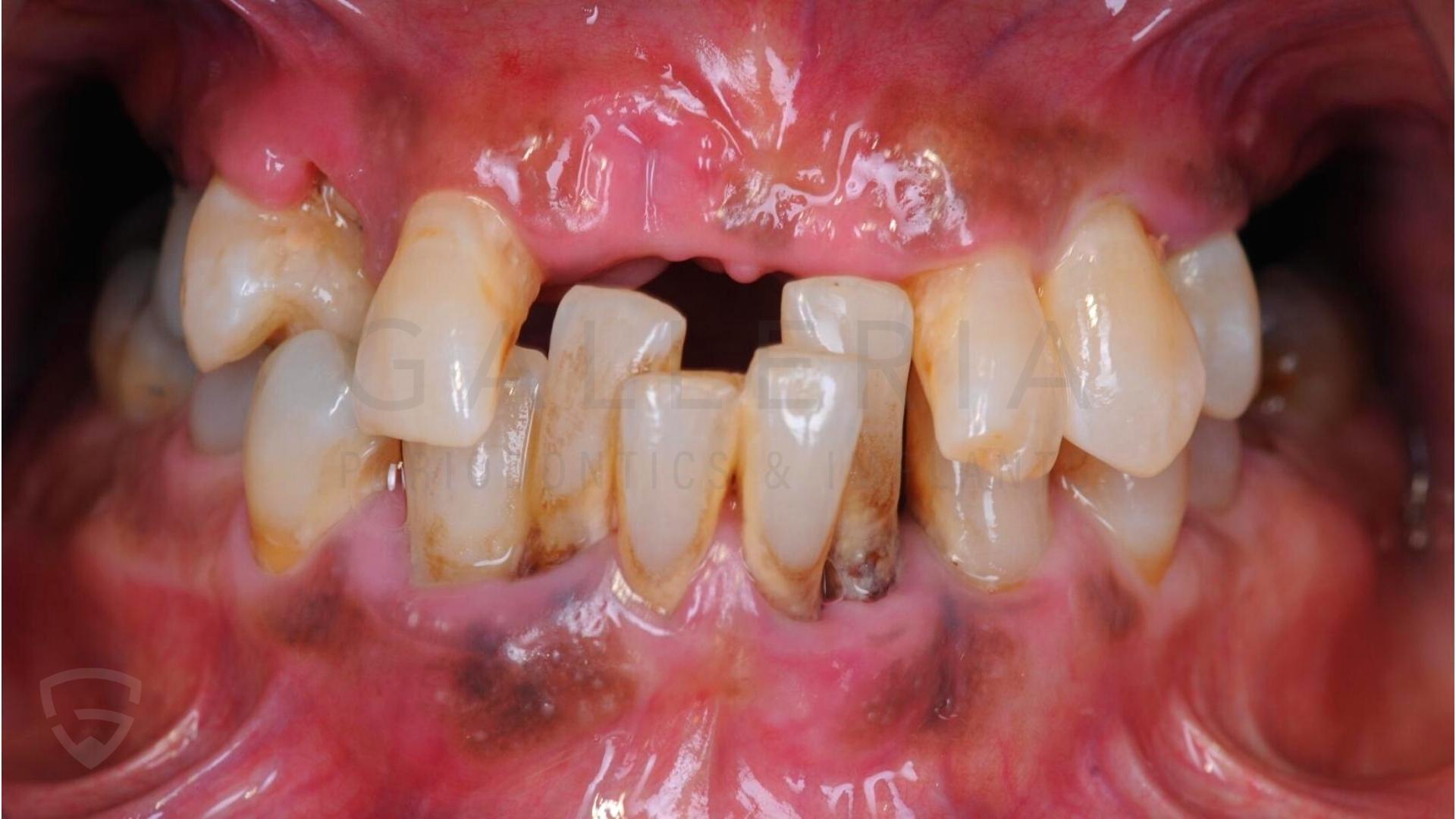 incomplete teeth