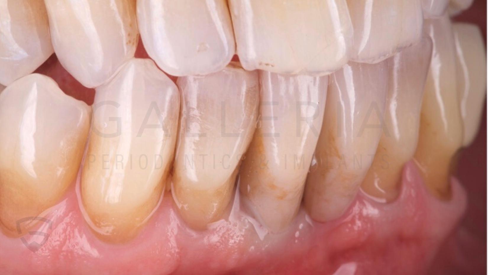 complete teeth results after dental implant
