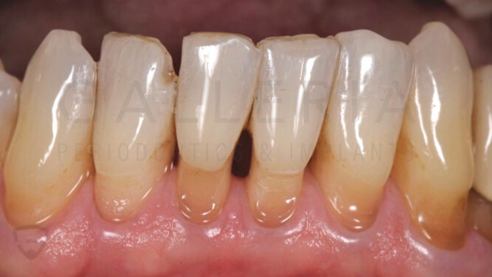diastema, gaps between teeth
