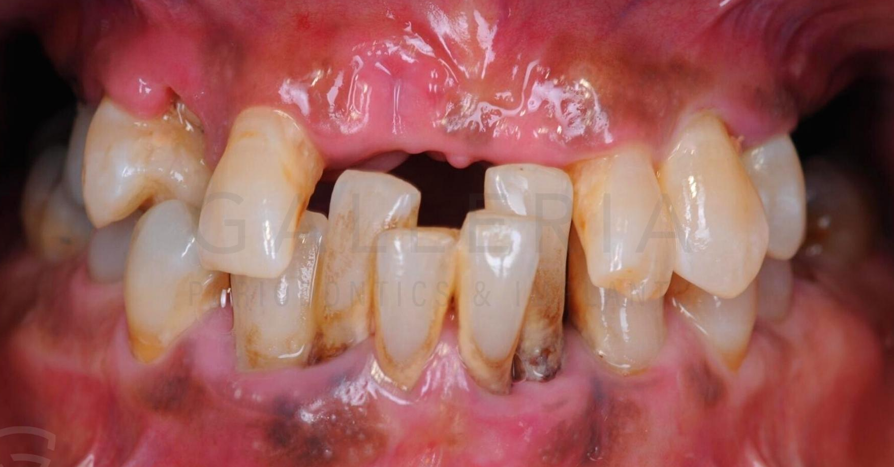 incomplete teeth