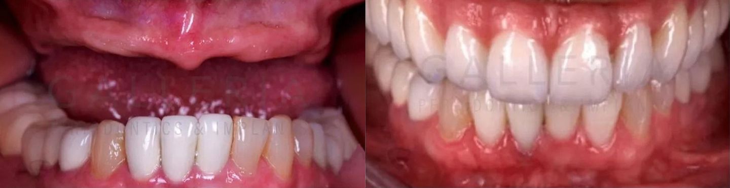 Fixed Full Arch Implant Treatment (all on 6)