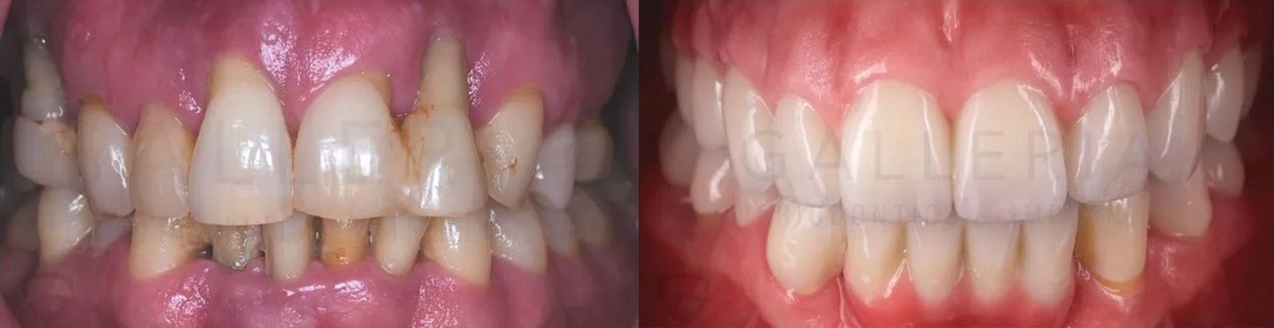 Full Mouth Restoration with Fixed Implants