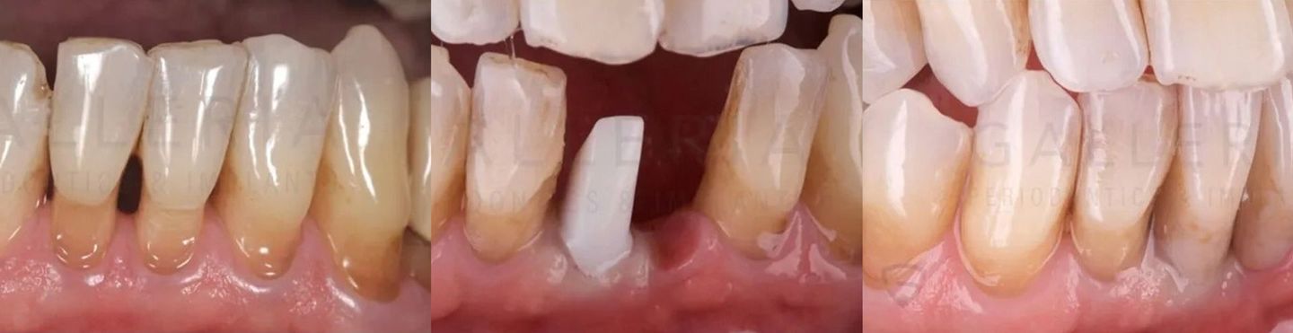 Hopeless Teeth Replacement with Implants