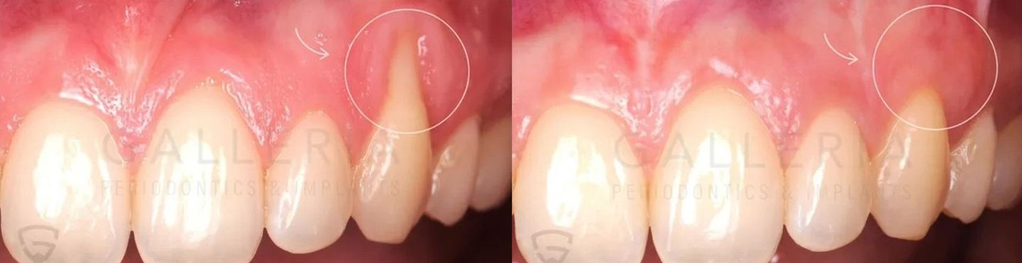 Recession Treatment with Tissue Grafting