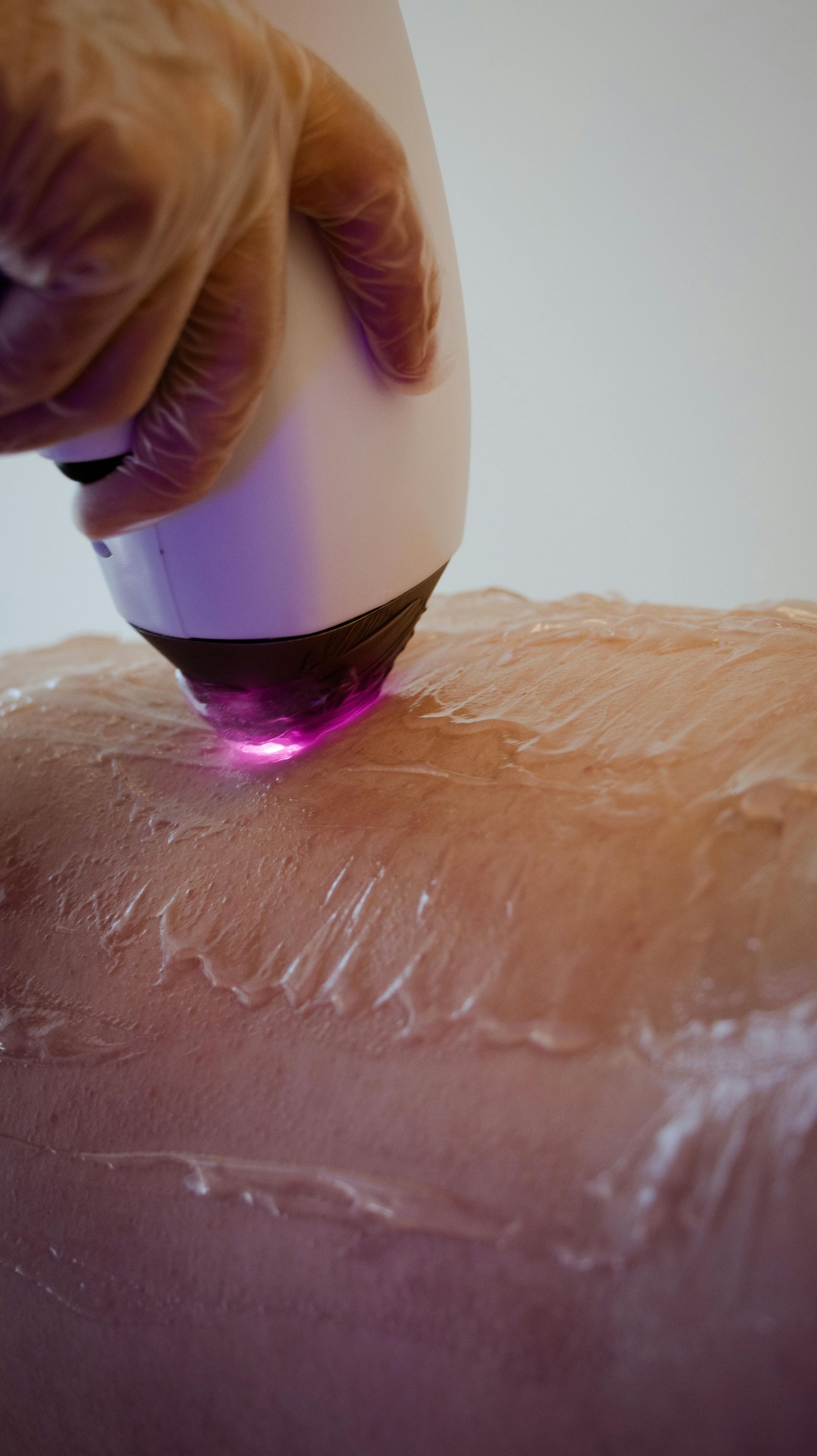 A person's skin being treated with a laser hair removal device.