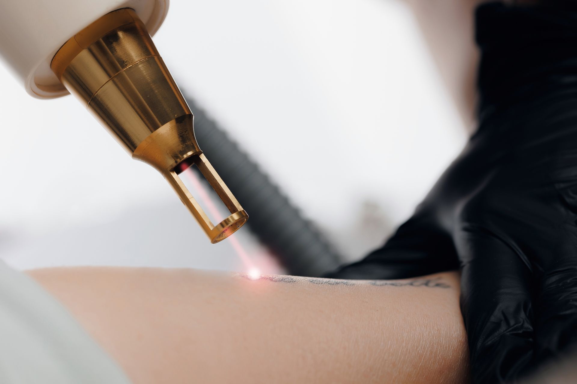 Laser tattoo removal procedure on an arm, with a gloved hand and a gold-tipped laser device.