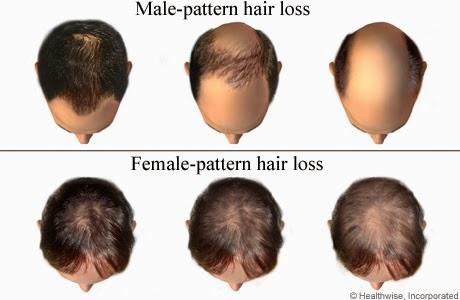 Hair Restoration | Olympia, WA | Natural Healing Family Medicine
