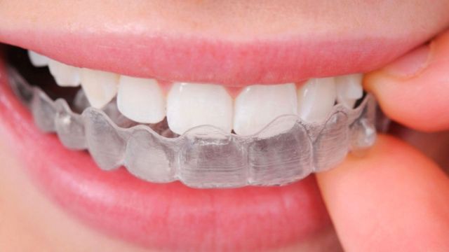 Bite Denti: Studio dentistico AED a Cesena bite dentale