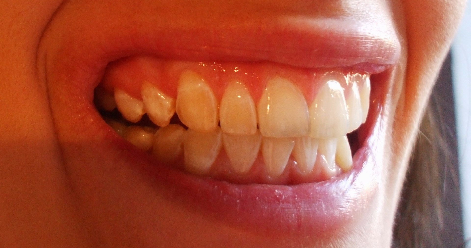 Sbiancamento denti come soluzione all'ingiallimento dei  denti: Studio dentistico AED a Cesena