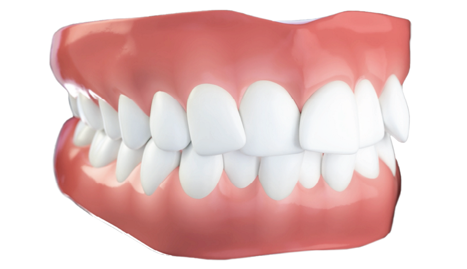 Denti Affollati tipo di malocclusione dentale - Studio dentistico AED Cesena