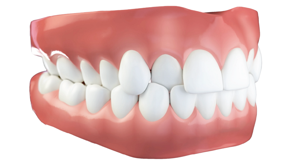 Morso crociato o Cross bite tipo di malocclusione dentale - Studio dentistico AED Cesena