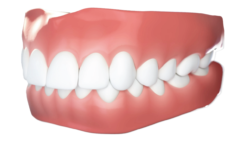 Morso profondo tipo di malocclusione dentale - Studio dentistico AED Cesena
