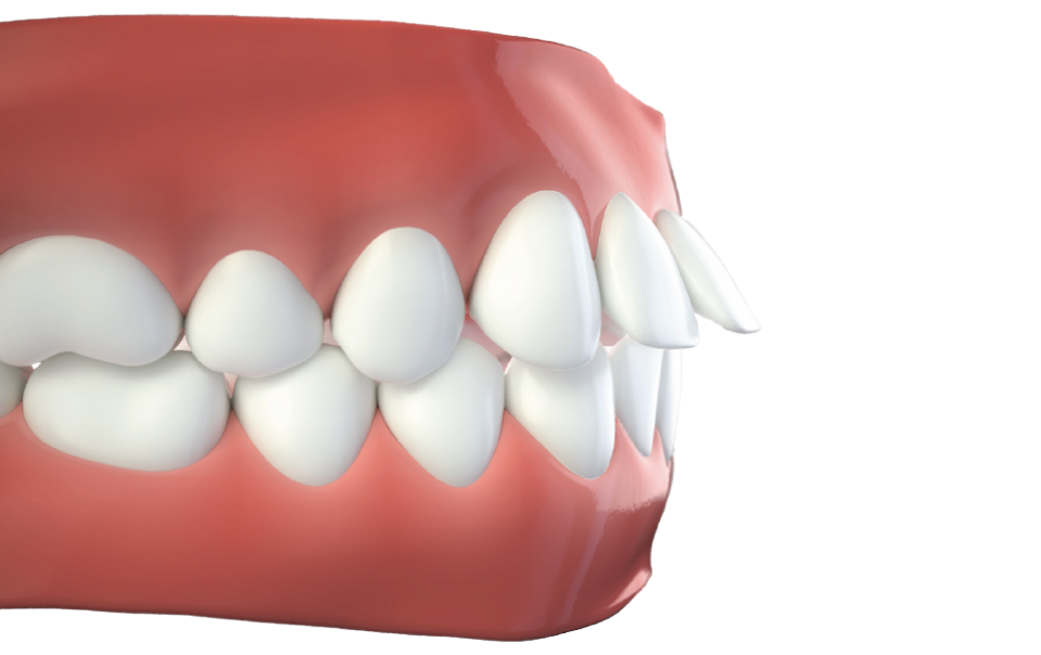 Overjet tipo di malocclusione dentale - Studio dentistico AED Cesena