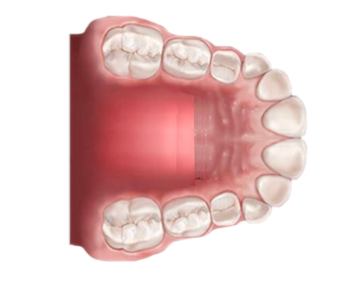 Palato stretto tipo di malocclusione dentale - Studio dentistico AED Cesena