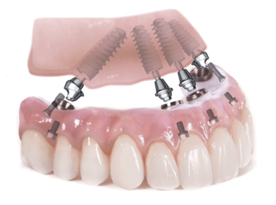 Implantologia  all on four per un impianto dentale a carino immediato presso lo Studio dentistico AED a Cesena