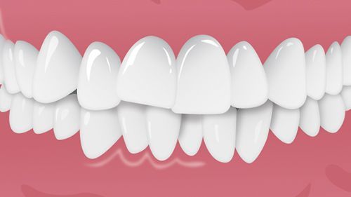 ClearCorrect Affollamento dentale - Studio dentistico AED