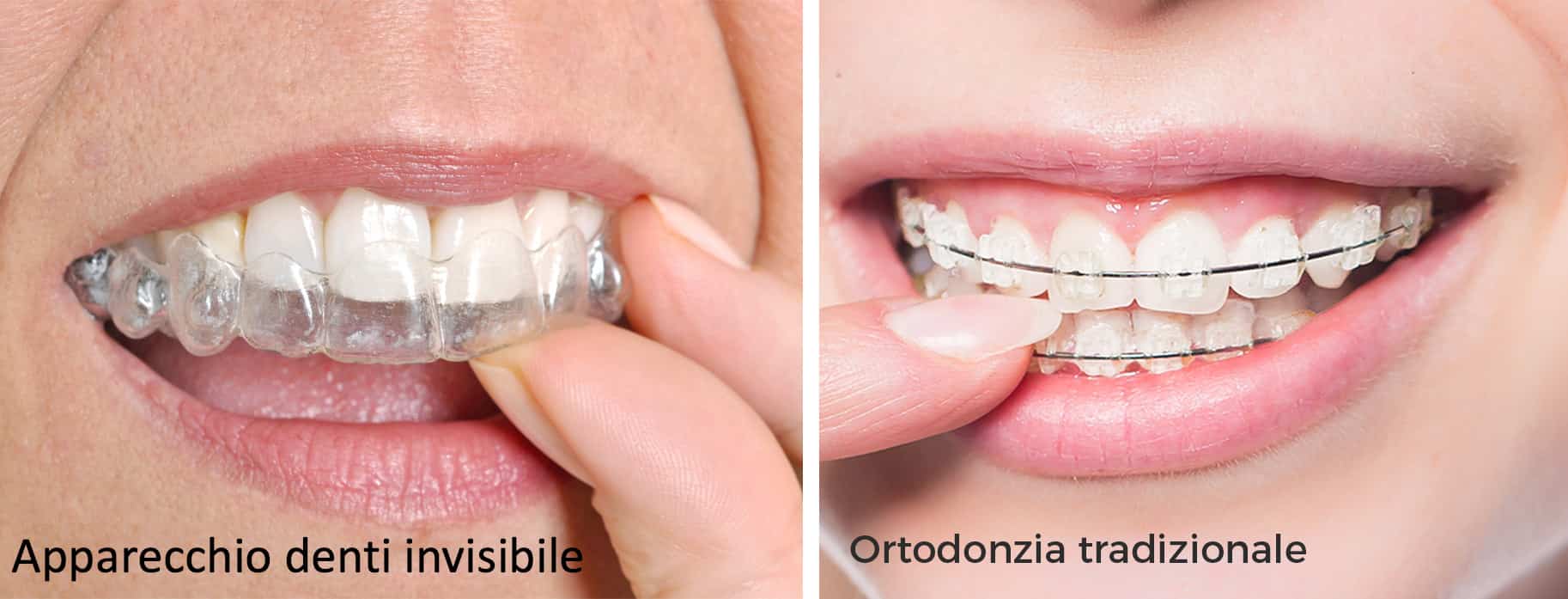 Invisalign apparecchio ortodontico invisibile - Studio dentistico AED a  Cesena