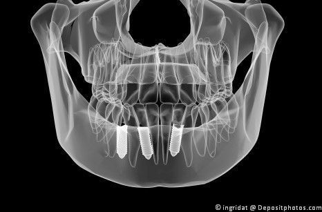 Digitaler Volumen-Tomograph für genaue Implantat-Positionierung