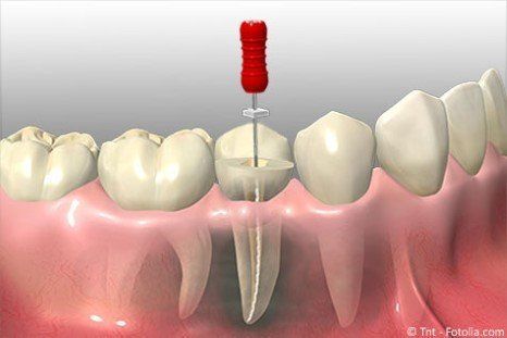 Gründlich wird das tote Gewebe entfernt, die Wurzelkanäle gereinigt, gespült und desinfiziert bevor der Zahn wieder verschlossen wird.