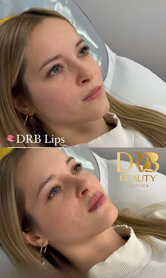 Comparación de los labios de una mujer antes y después de un procedimiento cosmético.