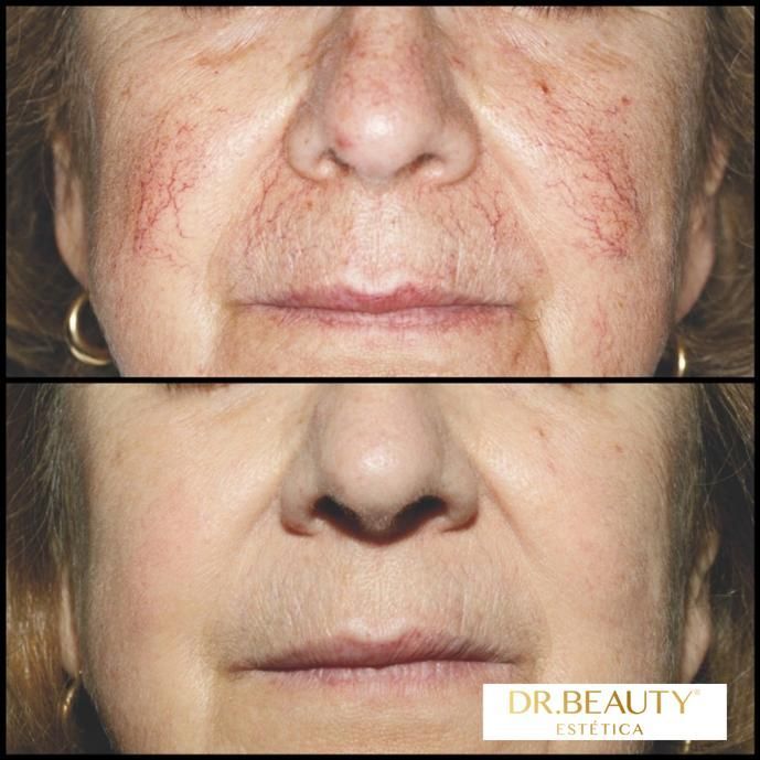Comparación del rostro de una mujer antes y después del tratamiento.