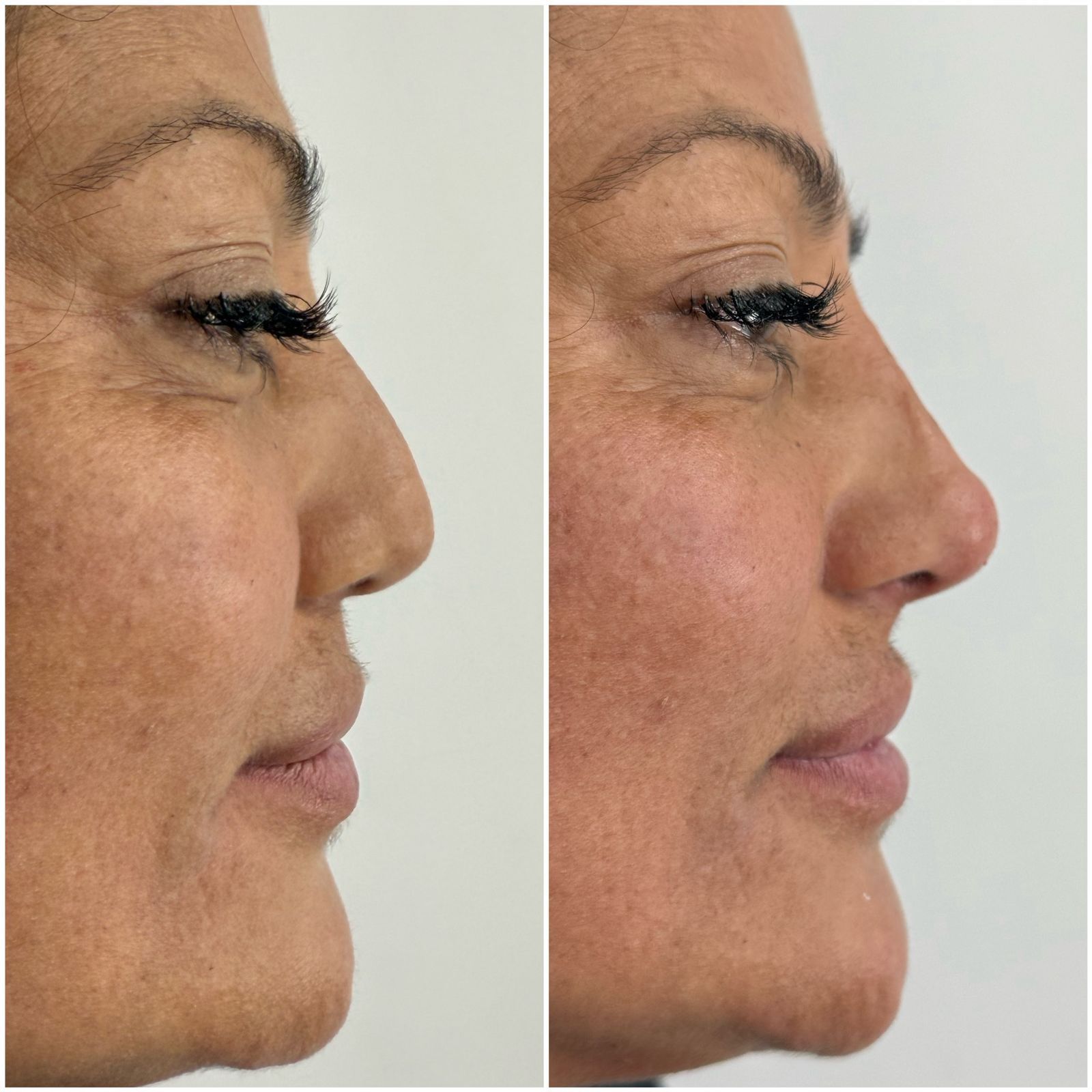 Vista de perfil antes y después del rostro de una mujer, que muestra los efectos de una remodelación de nariz no quirúrgica.