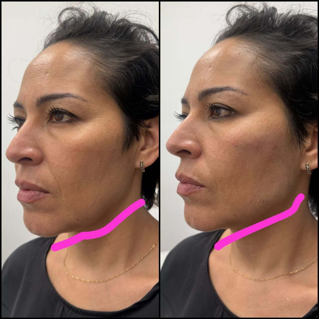 Fotos comparativas del rostro y cuello de una mujer antes y después de un procedimiento cosmético.