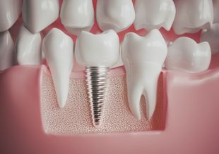 A 3D model of a dental implant service provided by Paulson Dental as part of their restorative dentistry in Sioux Falls, SD.