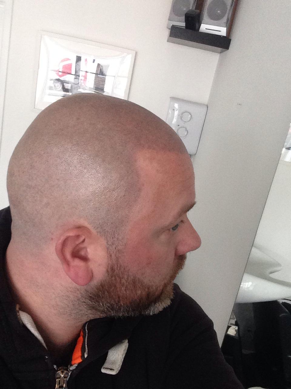 SMP Hair Solutions 22