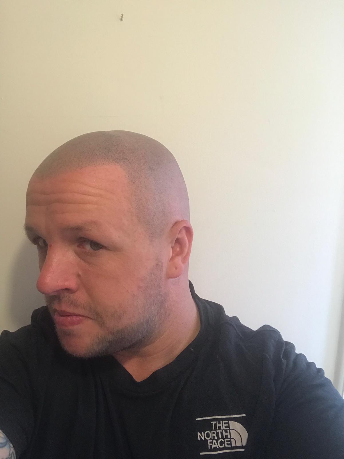 SMP Hair Solutions 35