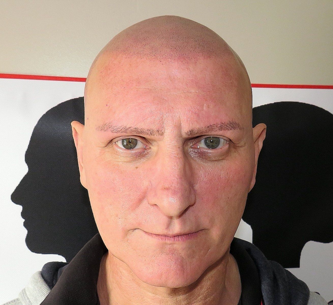 SMP Hair Solutions 44