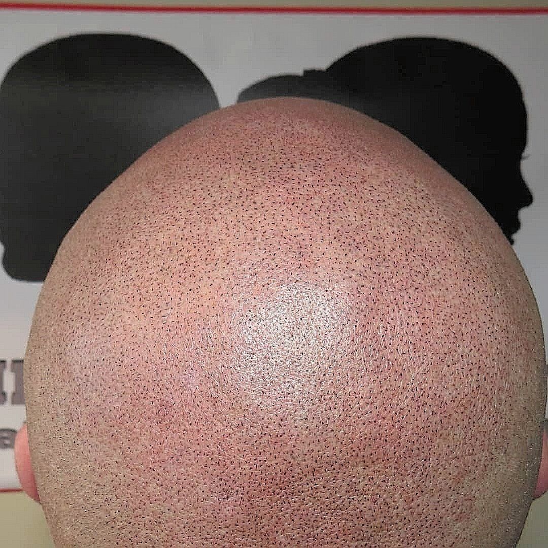 SMP Hair Solutions 26