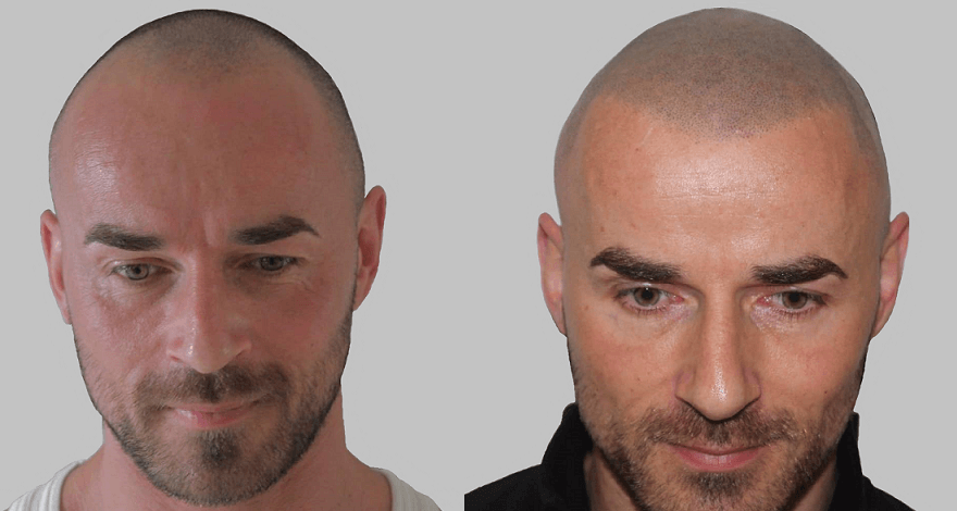 SMP Hair Solutions 67