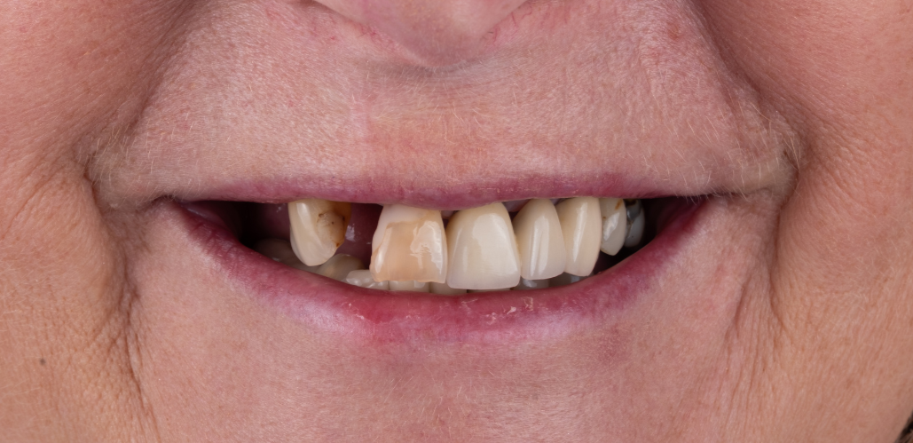 Close-up of a person's smile, showing discolored and missing teeth.