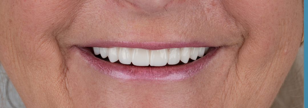 Close-up of a person's smiling mouth, showing straight, white teeth and wrinkles around the lips.