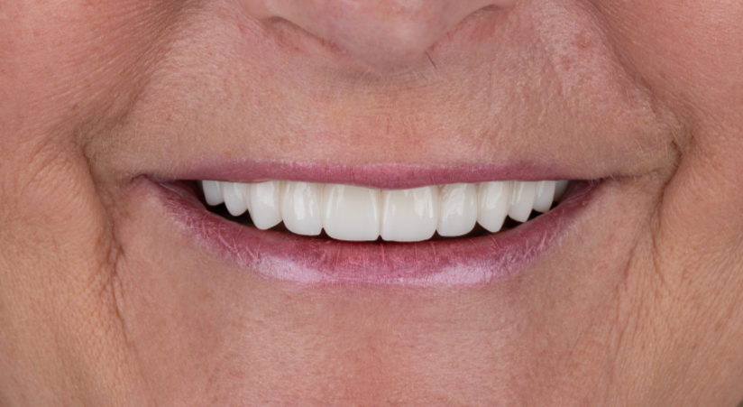 Close-up of a woman's smile, showing bright, white teeth. Pink lips, visible skin.