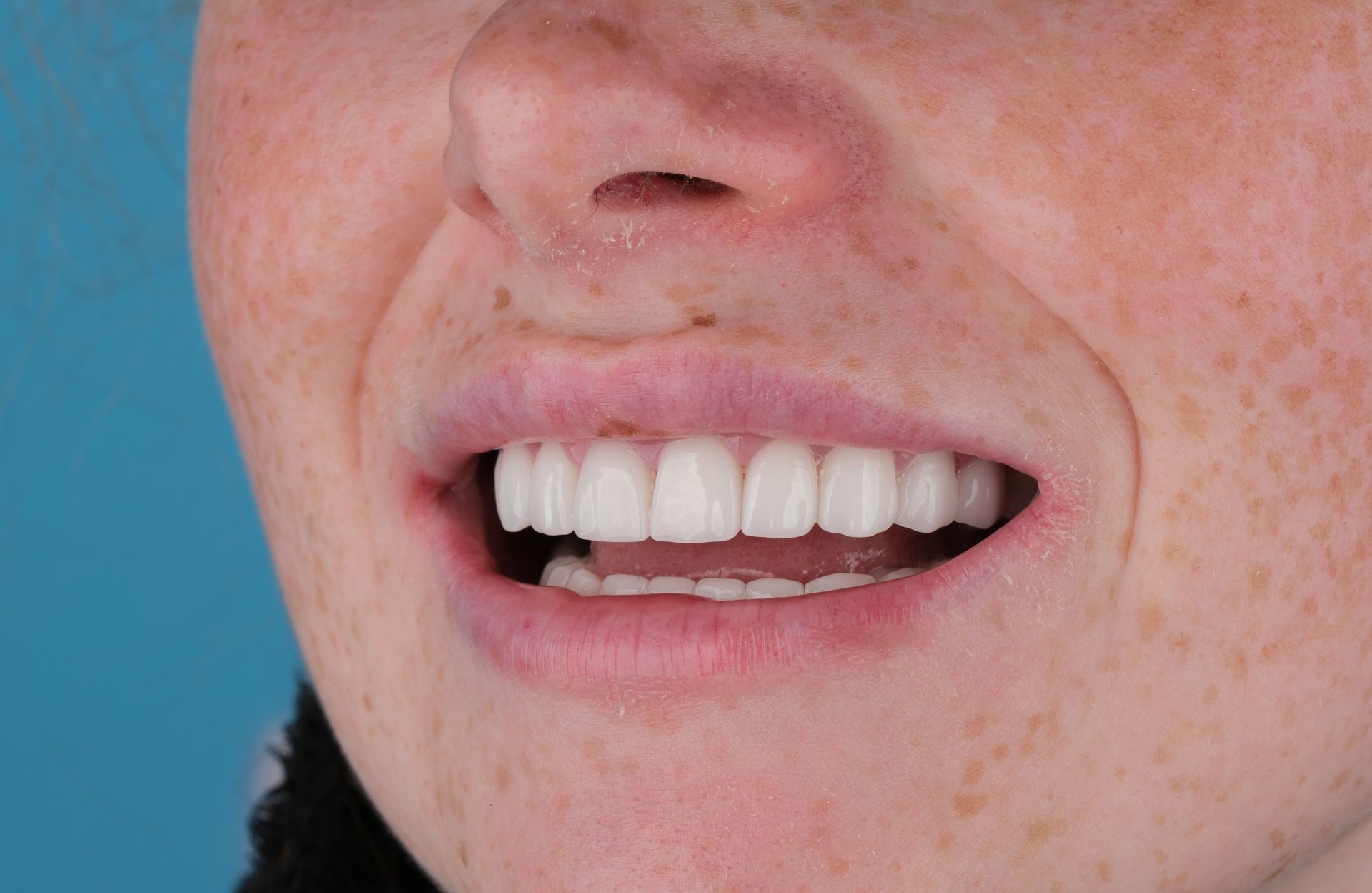 Woman with bright white, evenly-spaced teeth, smiling; freckled skin and a blue background.