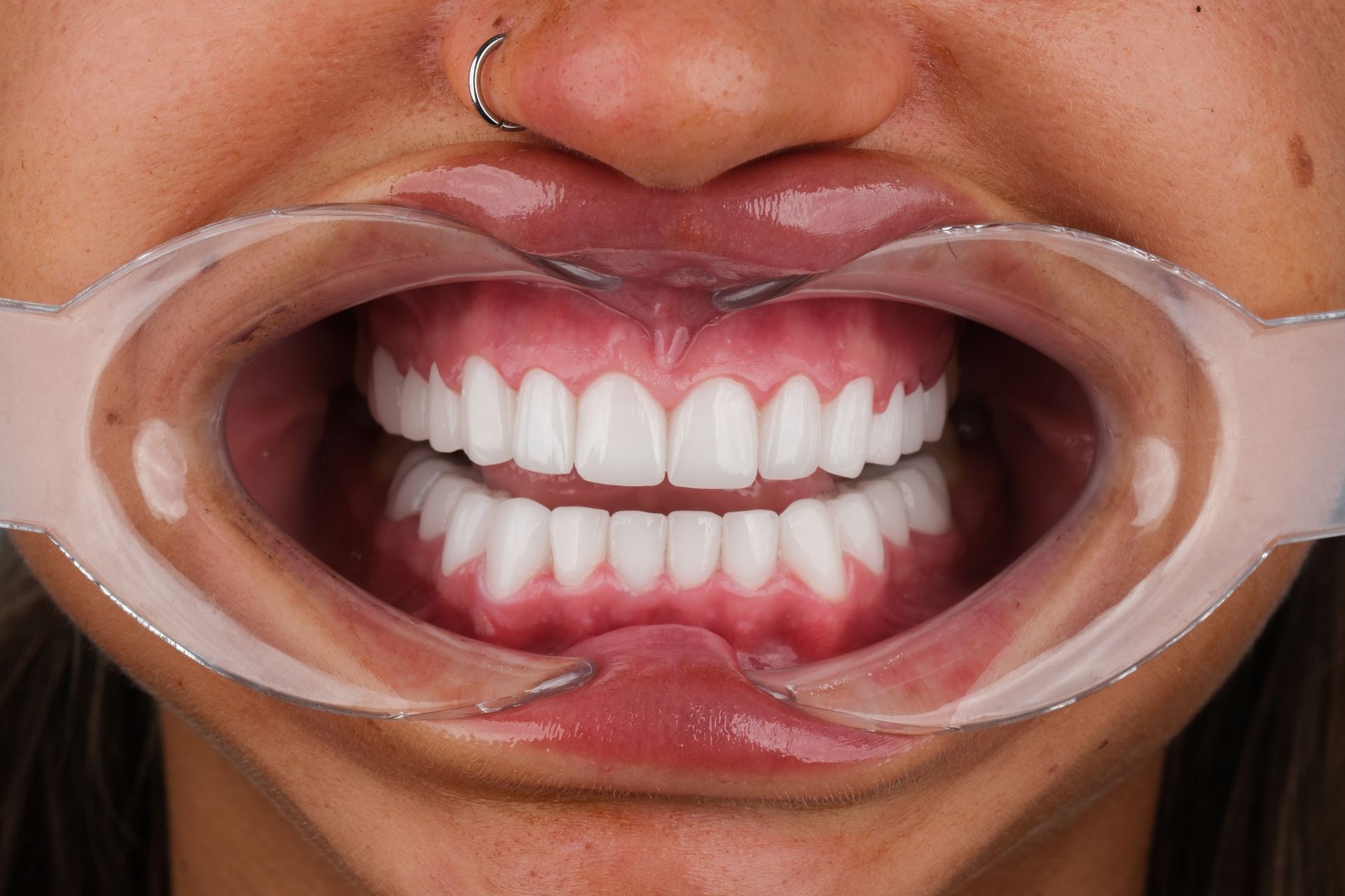 Person with mouth held open by retractor, showing bright, white teeth and pink gums.