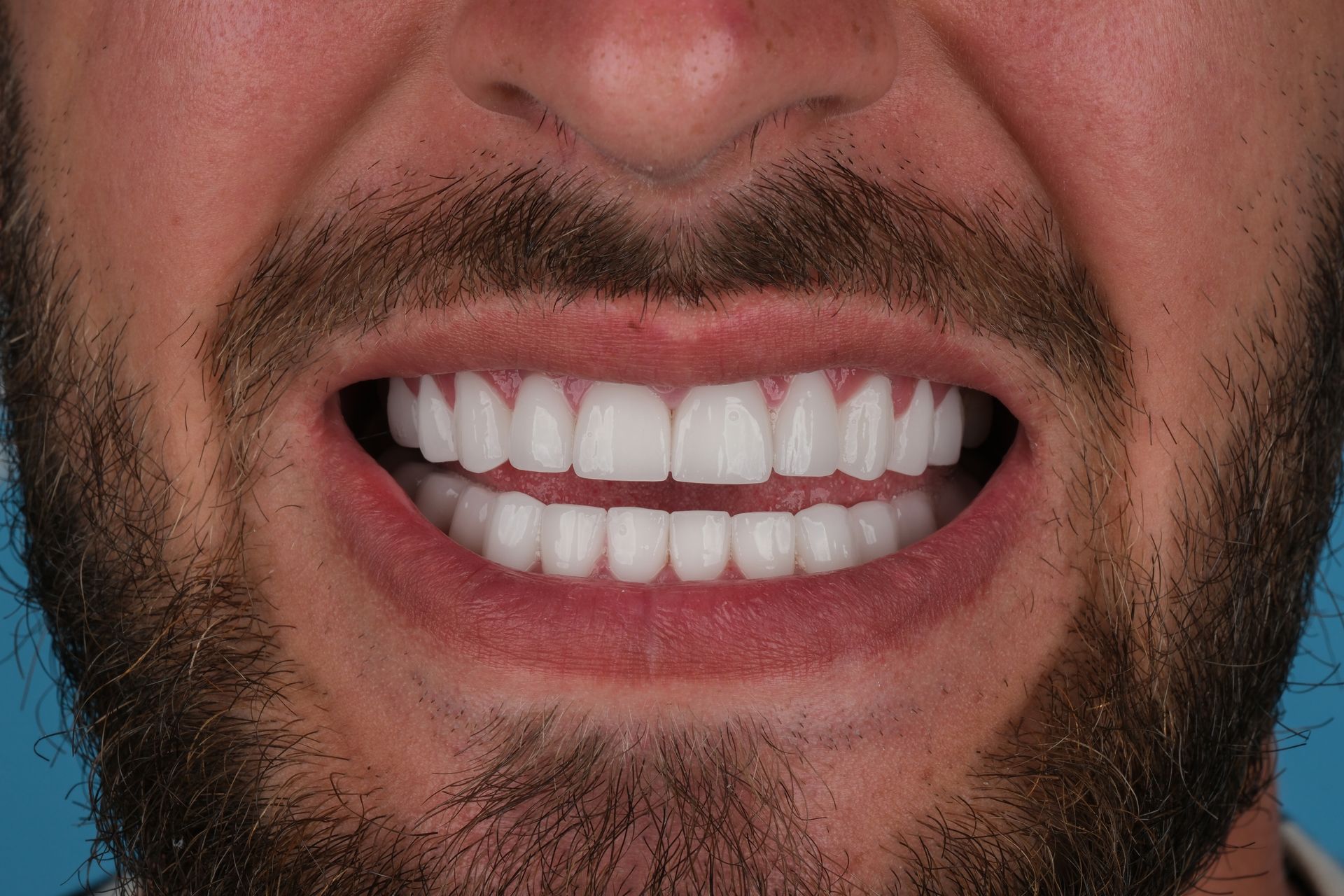 Man's mouth open, showing bright white teeth, dark beard, and a slightly furrowed brow.