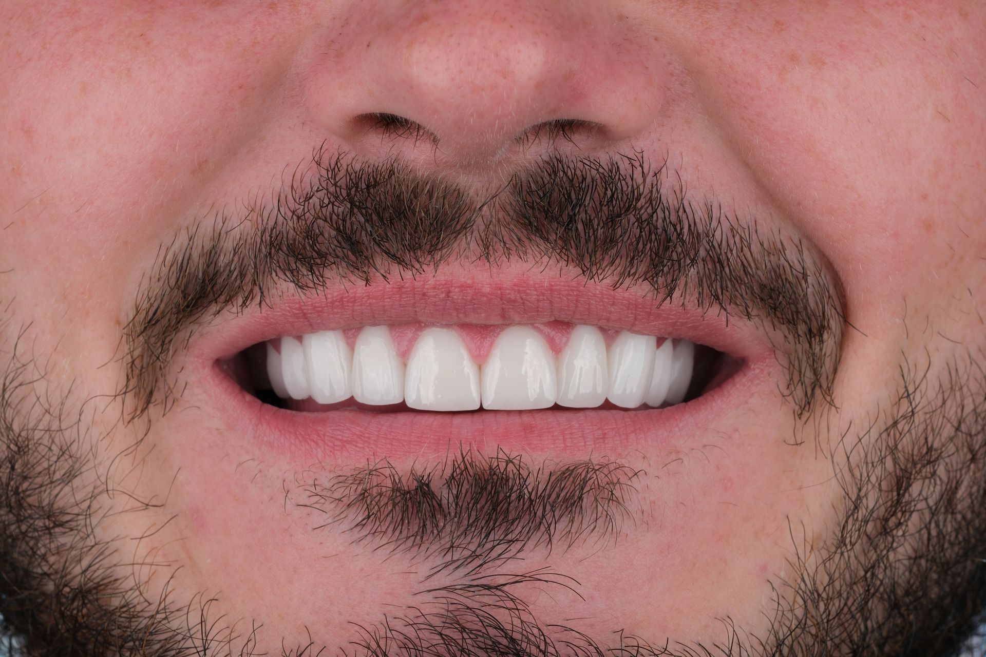 Close-up of a smiling man with a beard, showing bright white teeth.