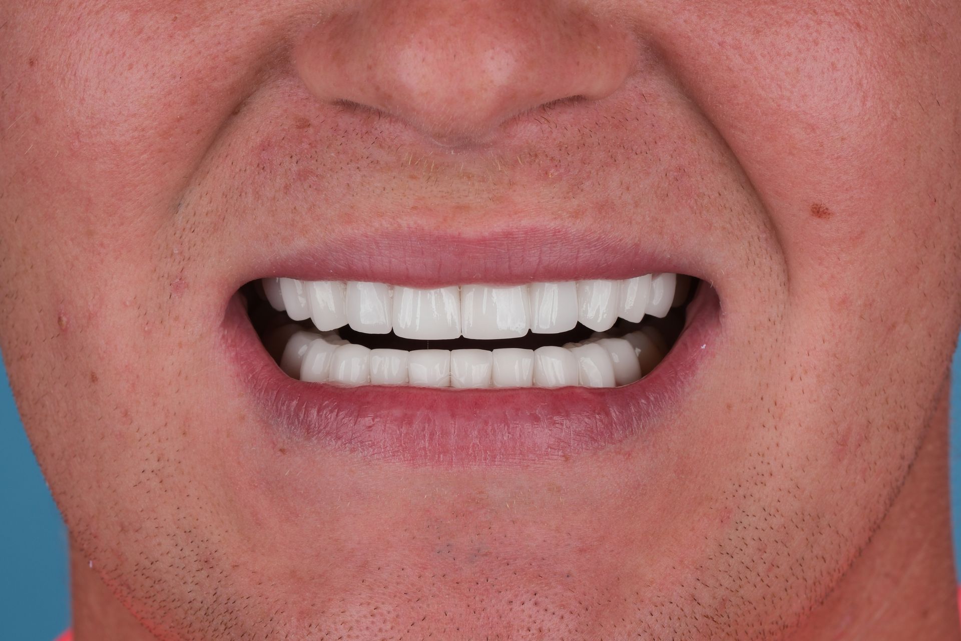 Close-up of a person's mouth with bright white teeth, showing an expression of exertion or strain.