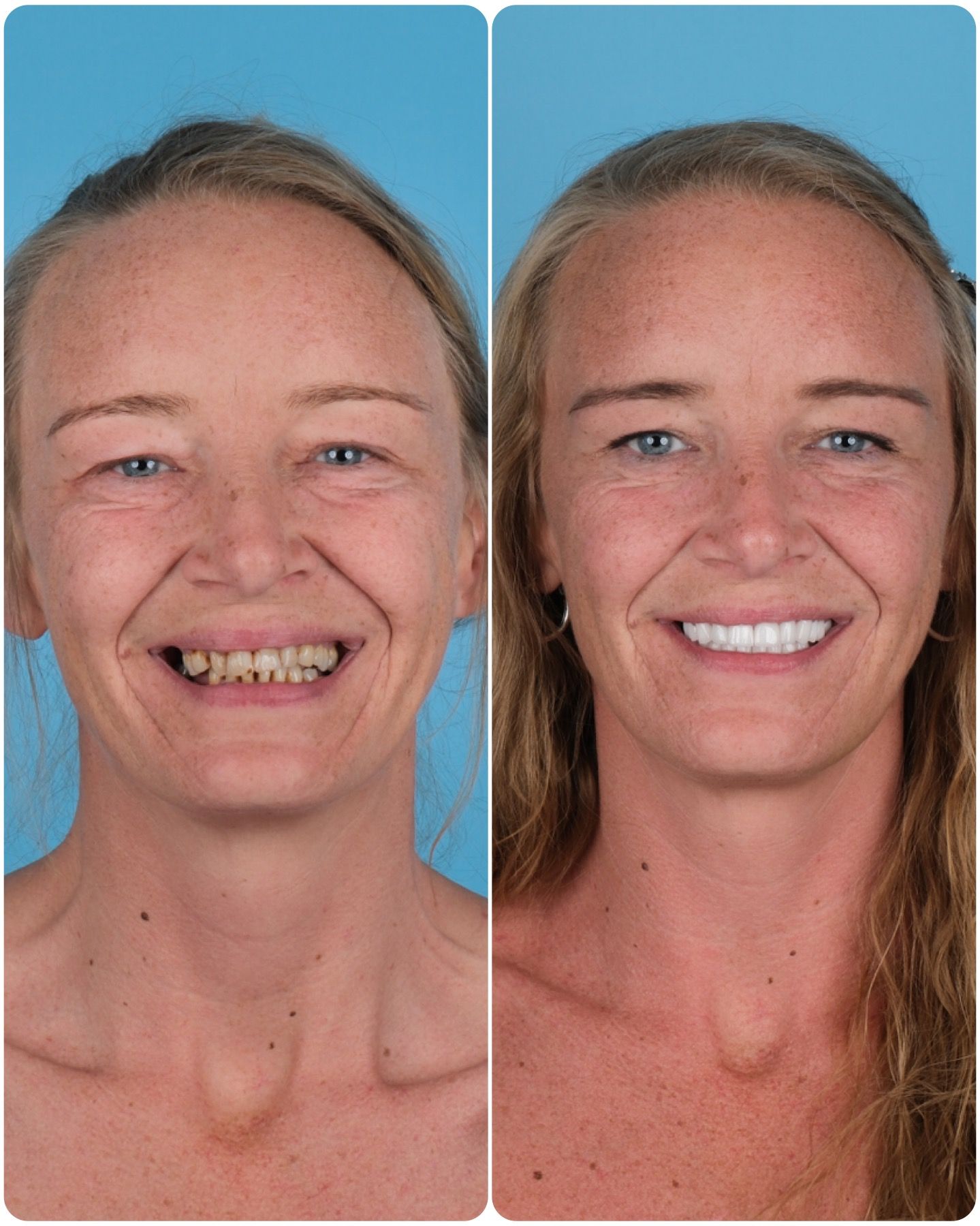 Woman before and after dental work, smiling. The after shows white, straight teeth.