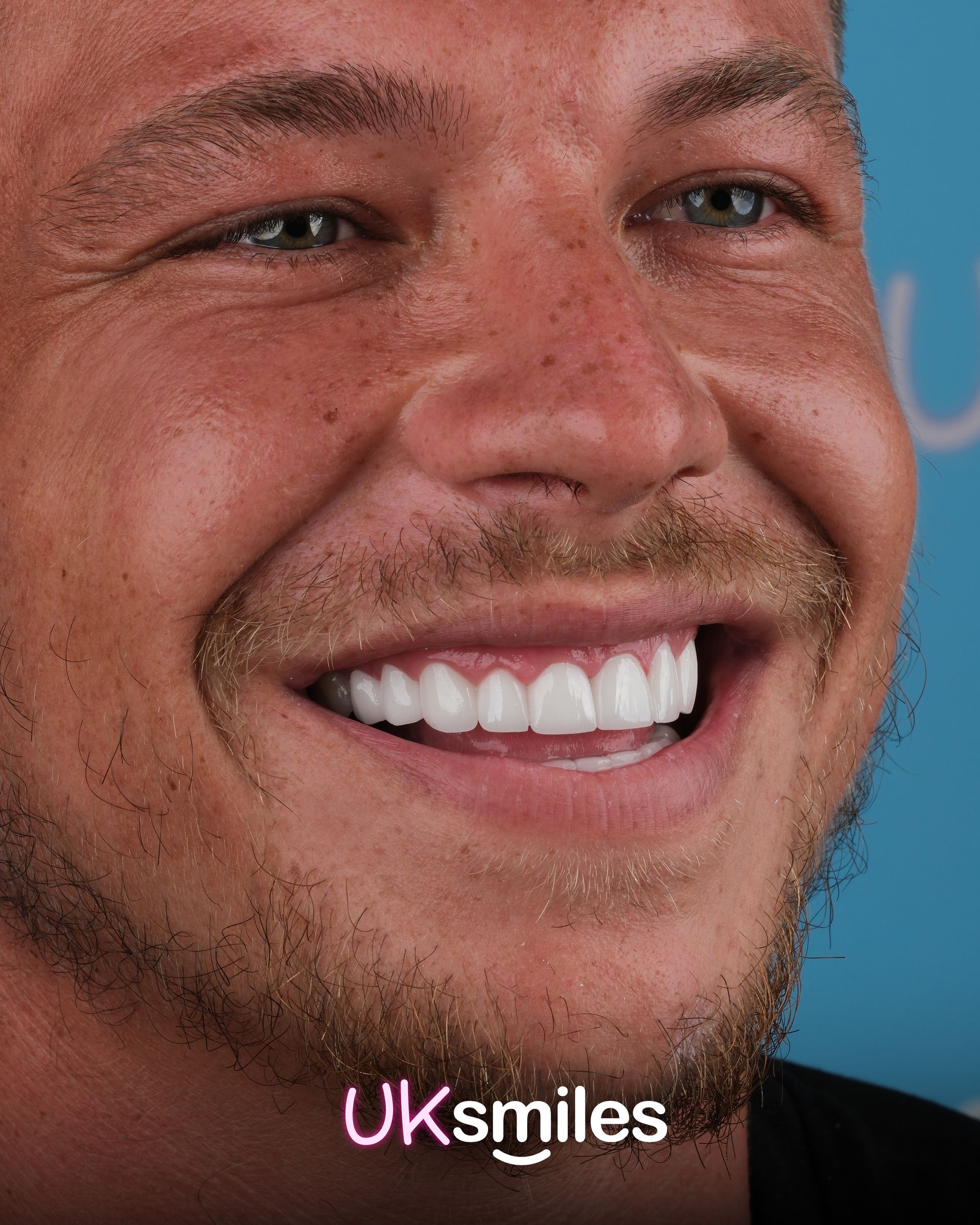 Man smiling, showing off bright white veneers; blue background.
