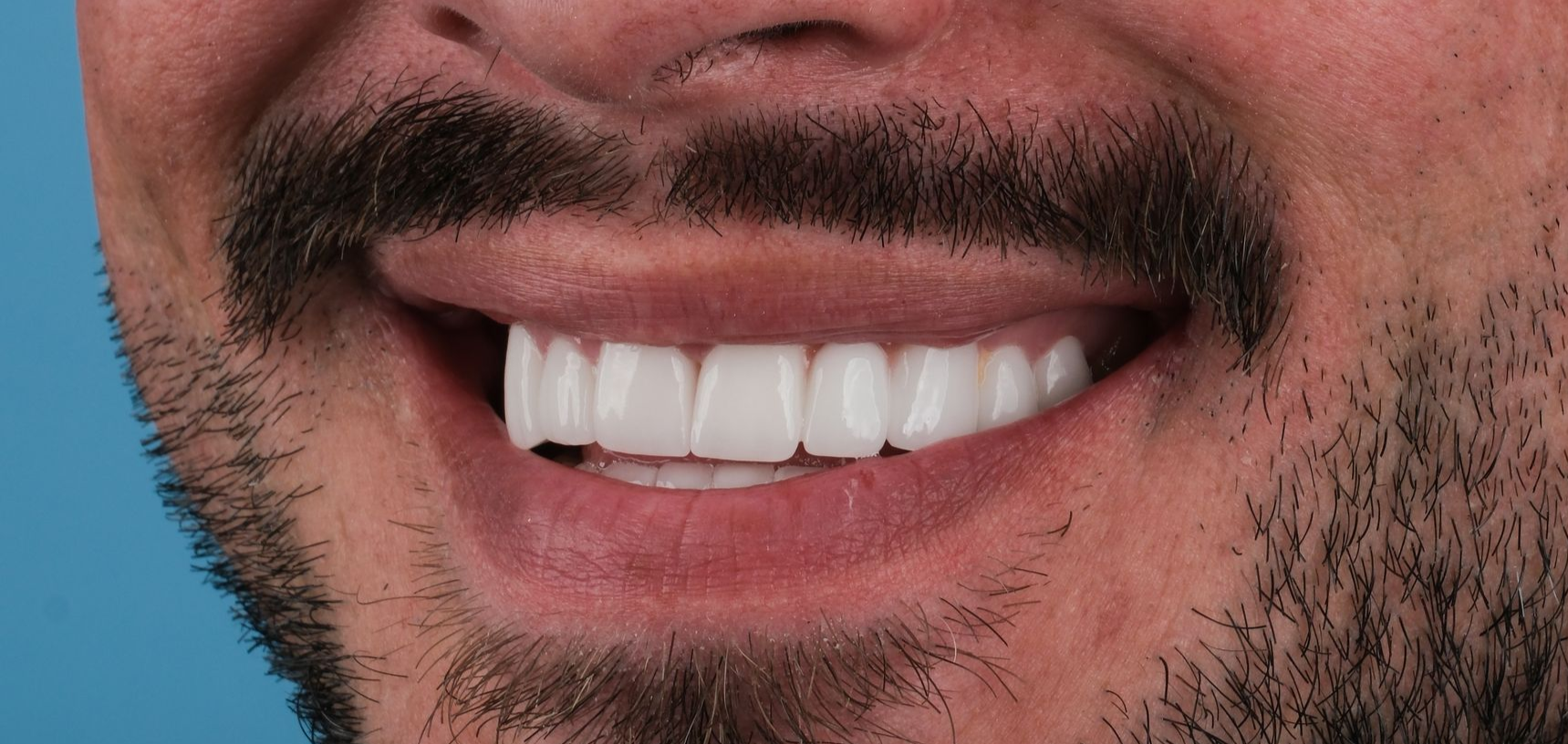 Close-up of a man with a full beard and a big smile showing off bright white teeth.