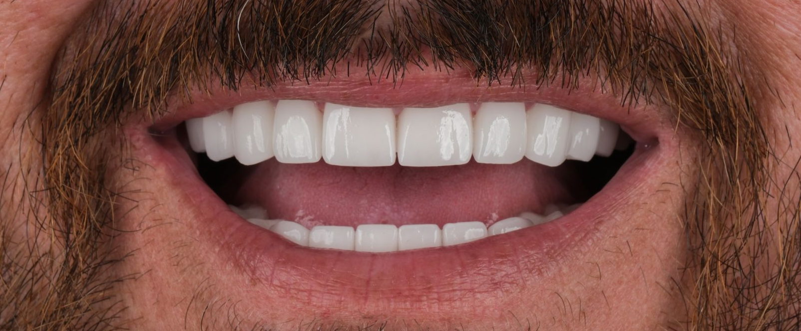Close-up of a man smiling widely, revealing bright white teeth, with a brown mustache and beard.