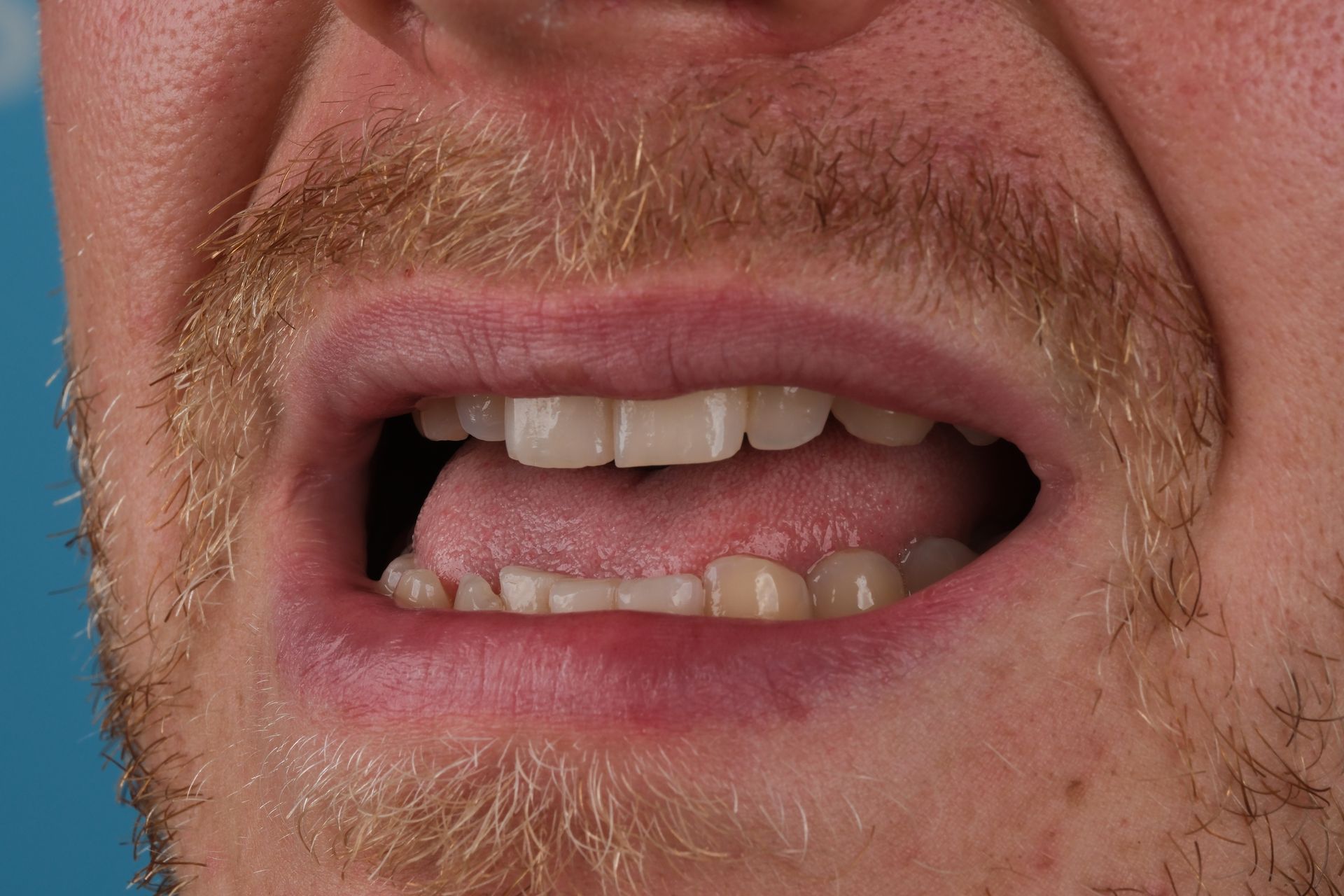 Close-up of a man's mouth open, tongue visible, displaying teeth and facial hair, with a pained expression.