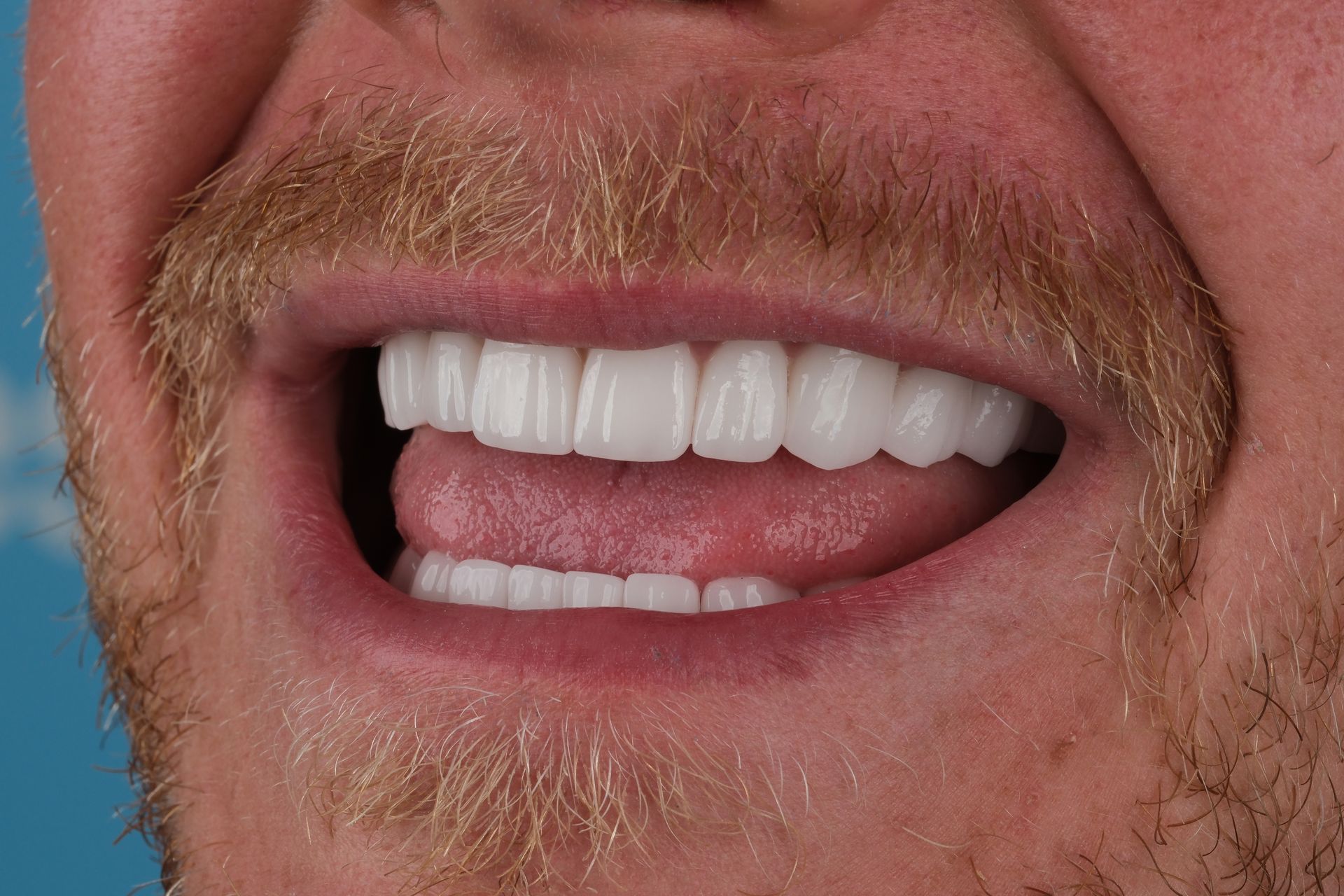 Close-up of a smiling man with a light beard, showing perfect white teeth and pink tongue.