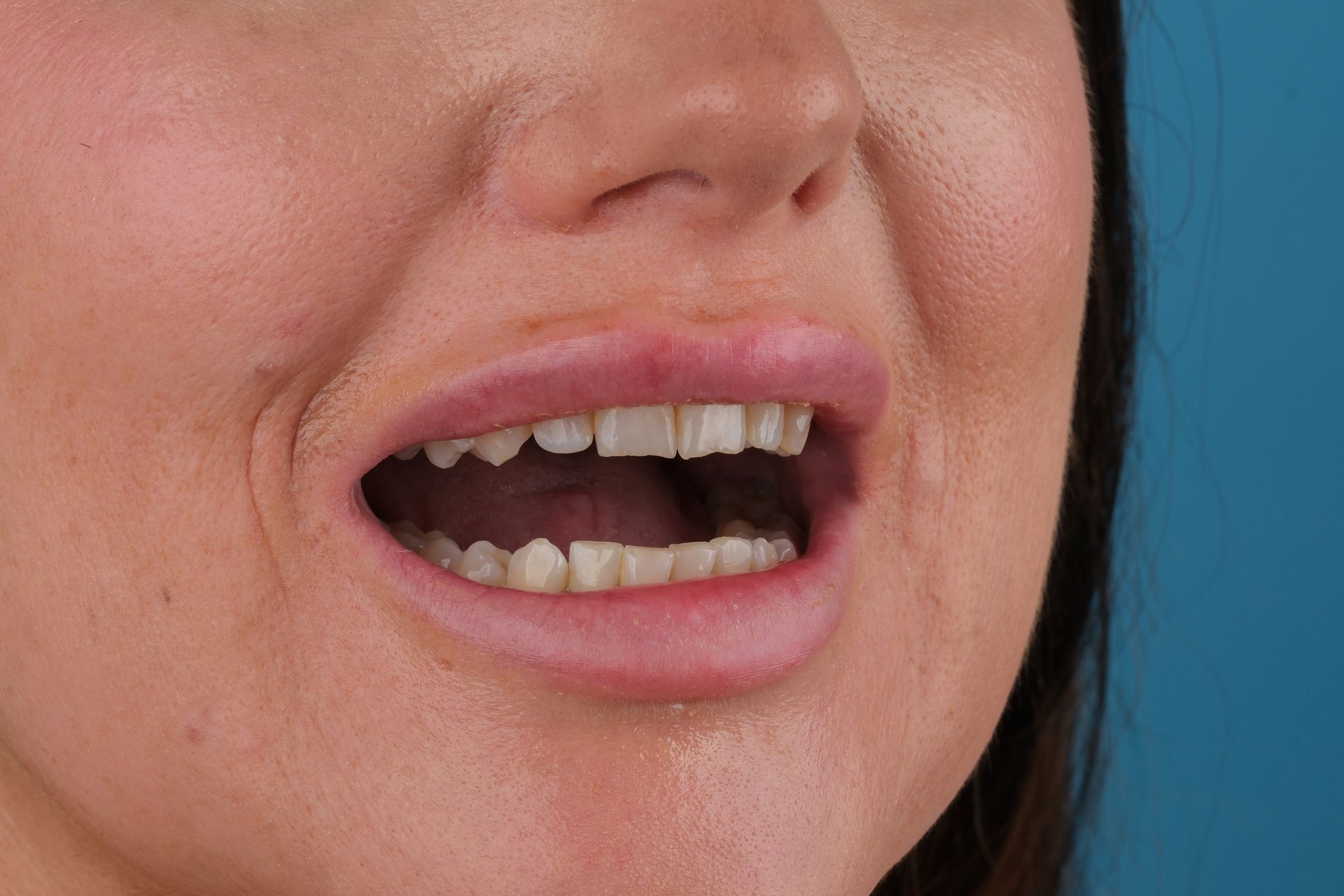 Close-up of a person's open mouth showing teeth. Skin is visible with a blue background.