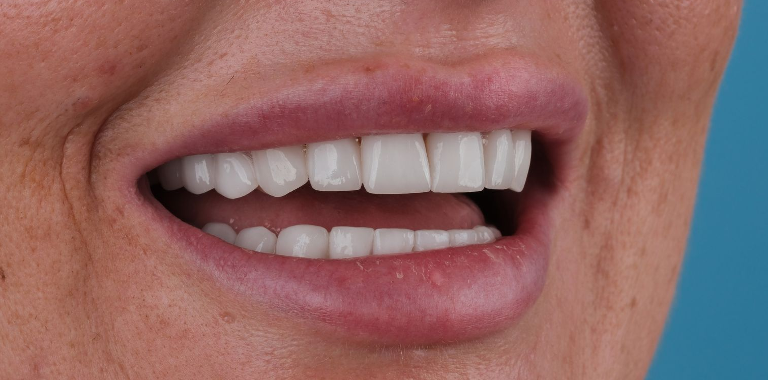 Close-up of a person's mouth, showing a wide smile with white teeth and pink lips.